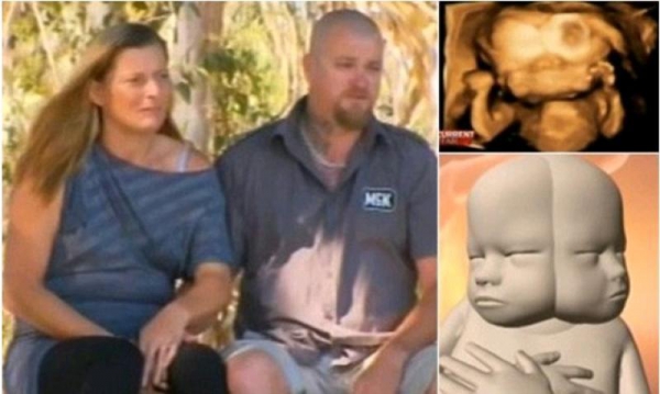 Супруги из Австралии ожидают сиамских близнецов 