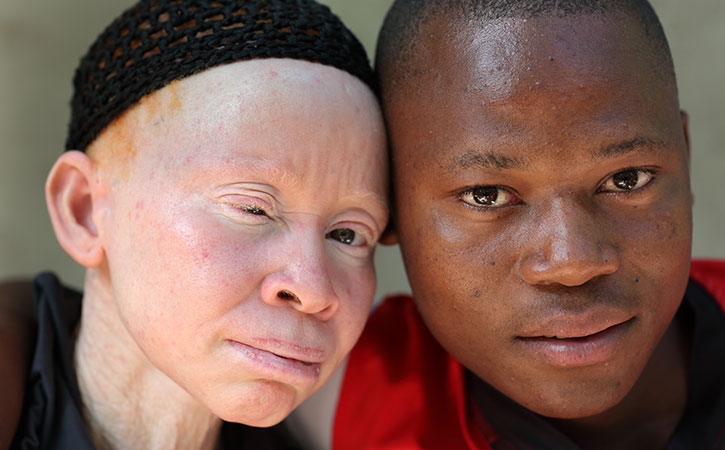 13 июня - Международный день распространения информации об альбинизме